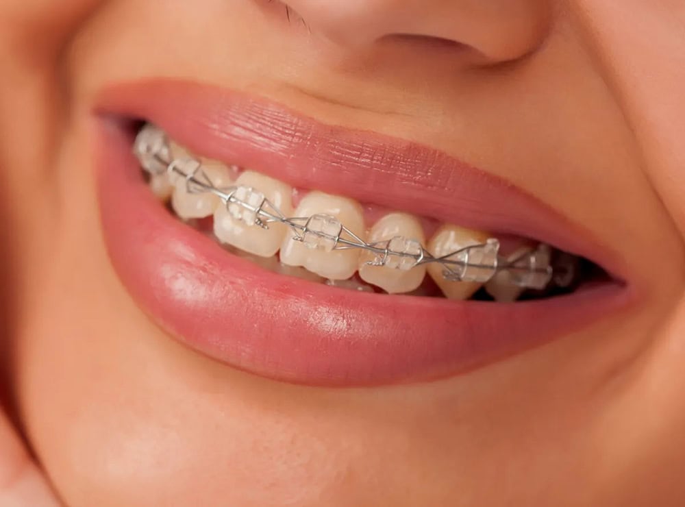 braces Puchong