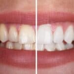 teeth whitening service Puchong