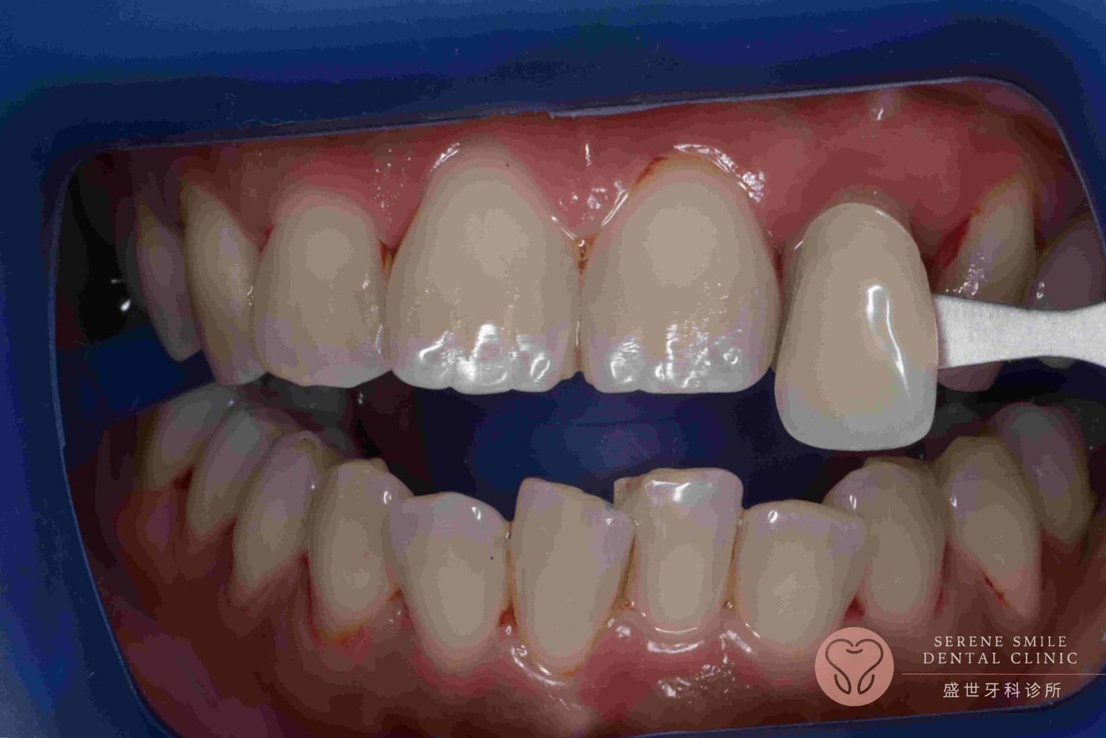 Can Veneers Fix Crooked Teeth? Puchong Cosmetic Dentist Answers