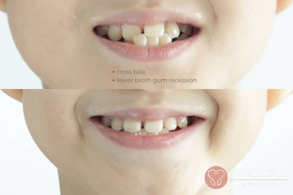 Emphasize Retention Children's Braces Puchong: When Should Your Child Start?