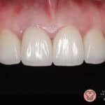 teeth whitening service Puchong