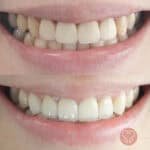 teeth whitening service Puchong