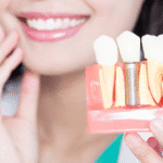 Dental Implant Puchong Price Guide