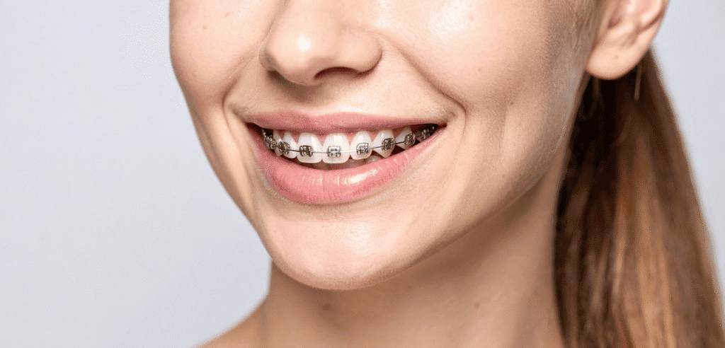 Ceramic Braces vs Metal Braces: Which is Best? - SS Dental Puchong