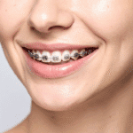 Teeth Braces Puchong: Metal vs Ceramic vs Clear Aligner