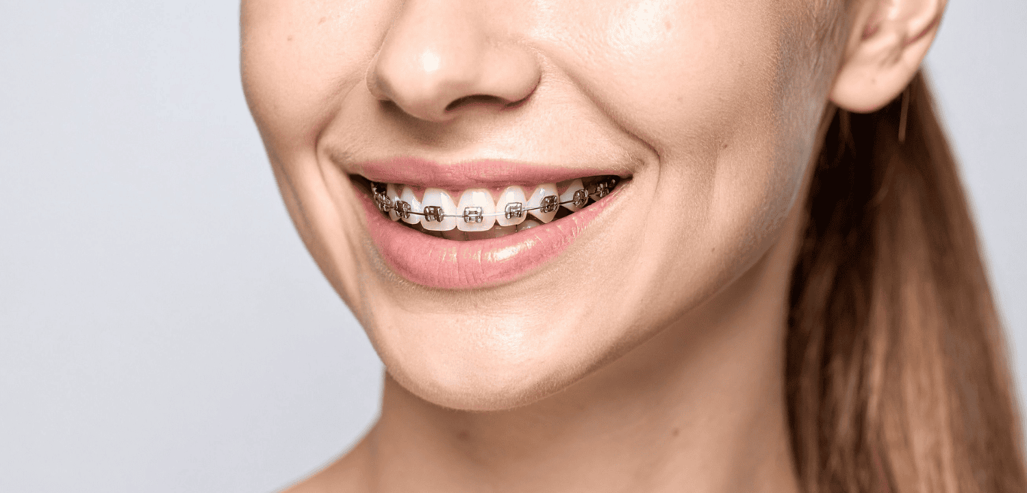 Teeth Braces Puchong: Metal vs Ceramic vs Clear Aligner