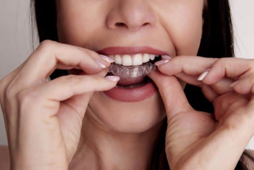 braces Puchong